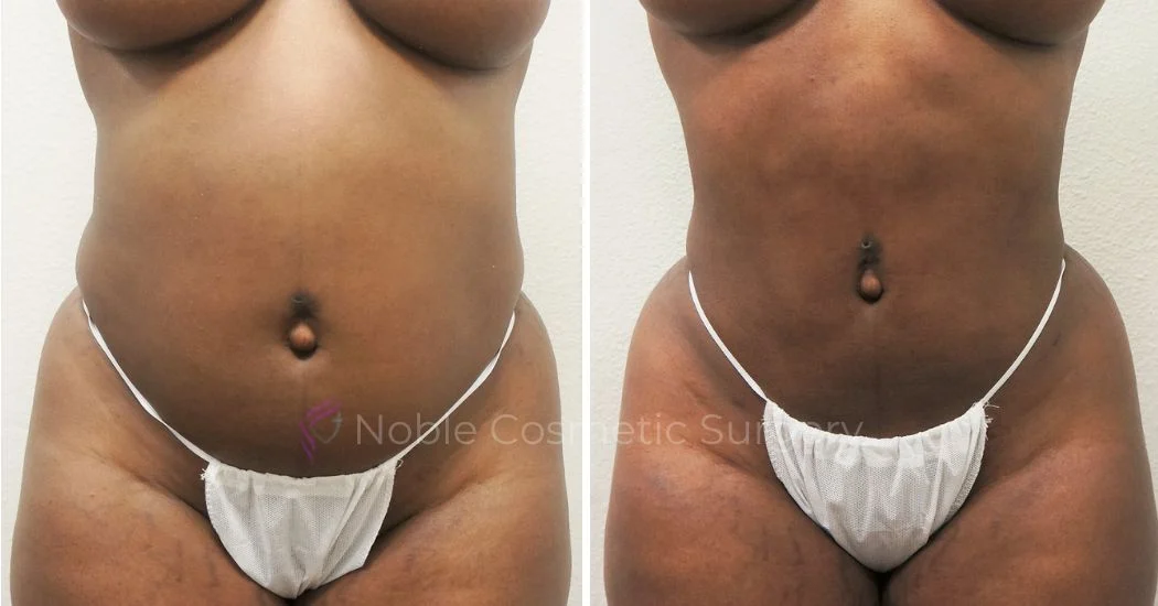 P7-00907L | Before and After Liposuction 1