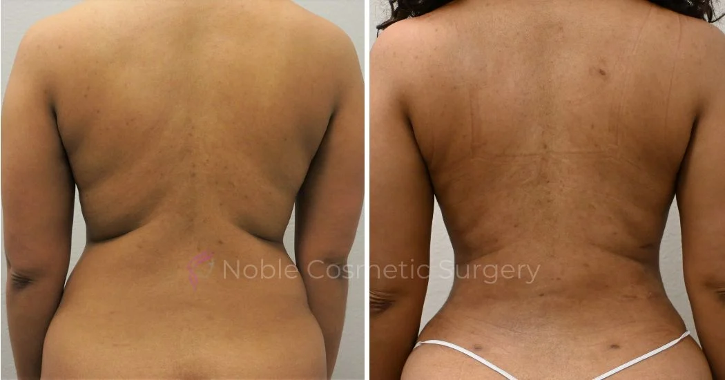 P9-00040A | Before and After Abdominoplasty 3