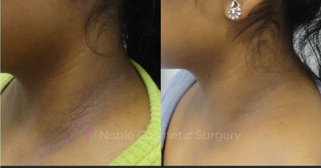 PICO-LASER-CASE-00002 | Before and After Pico Skin Rejuvenation 1