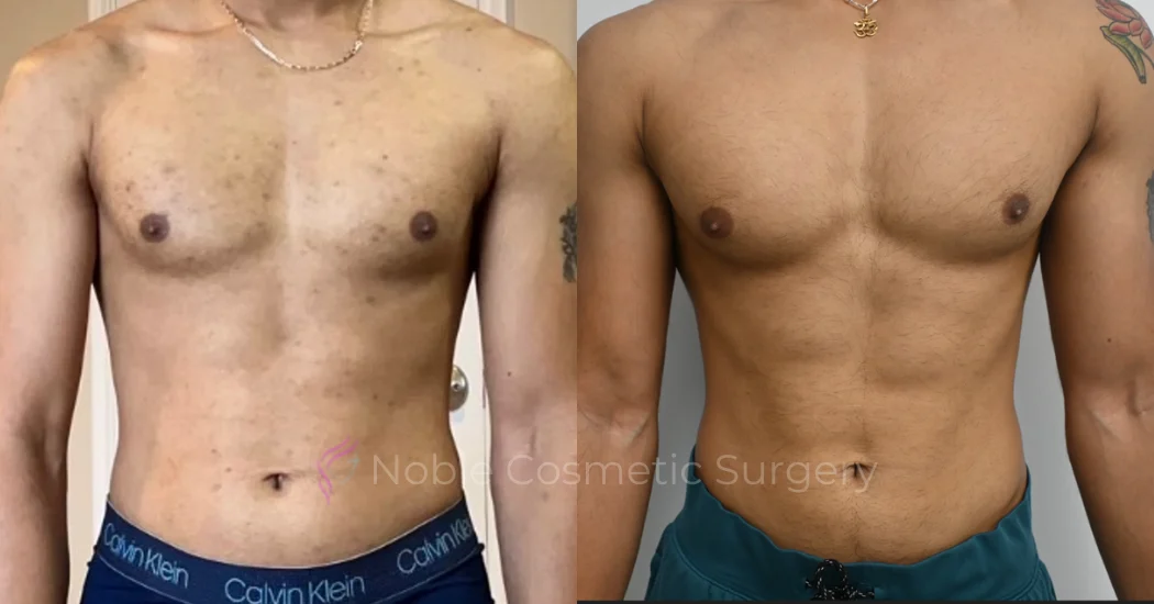 PICO-LASER-CASE-00004 | Before and After Pico Skin Rejuvenation 1