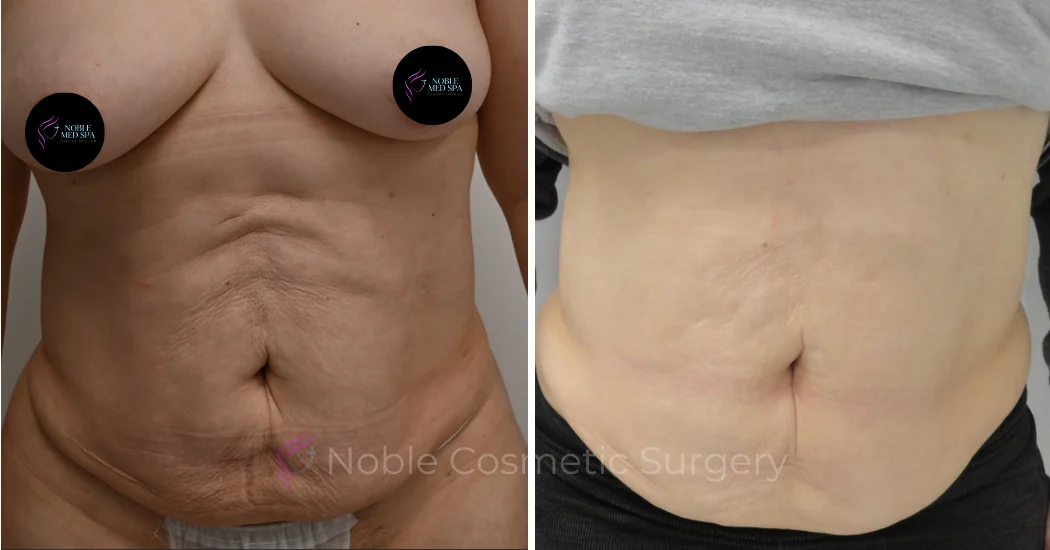RF-MICRONEEDLING--CASE-00010 | Before and After RF Microneedling 1