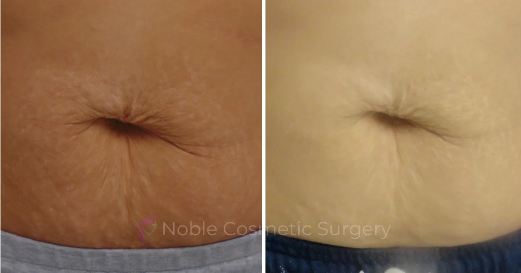 RF-MICRONEEDLING--CASE-00020 | Before and After RF Microneedling 1