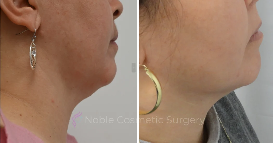 RF-MICRONEEDLING--CASE-00030 | Before and After RF Microneedling 1