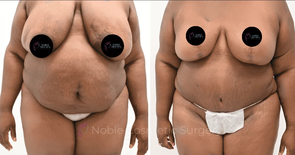 MOMMY-MAKEOVER-CASE-14343 | Before and After Mommy Makeover 1