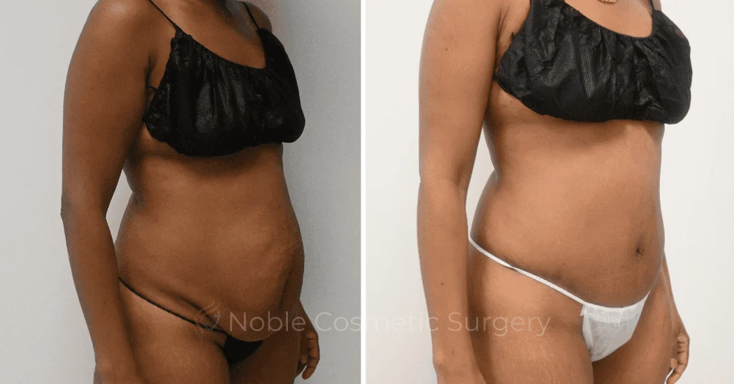 TUMMY-TUCK-CASE-12299 | Before and After Abdominoplasty 2