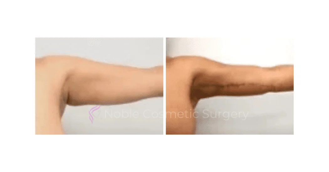 ARM-LIFT-CASE-00251 | Before and After Brachioplasty 1